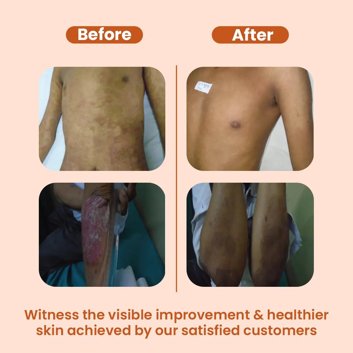 AyuDerme: A Natural Solution for Skin Disorders - Welex Care - Welex Care