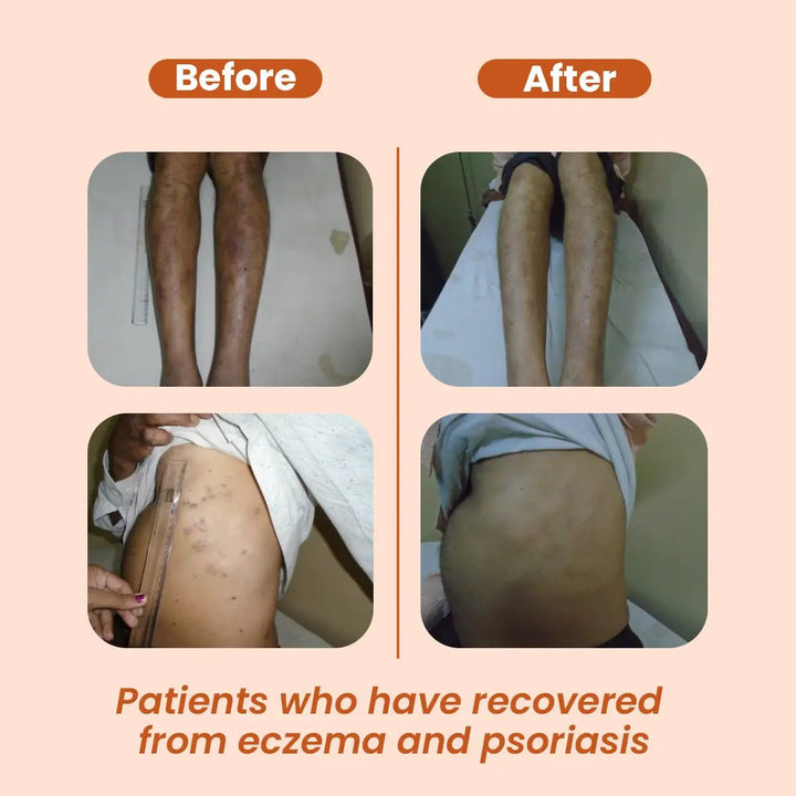 AyuDerme: A Natural Solution for Skin Disorders - Welex Care - Welex Care