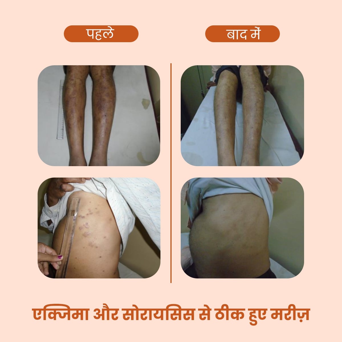 Welexcare: AyuDerme त्वचा की समस्याओं के लिए एक प्राकृतिक इलाज - Welex Care