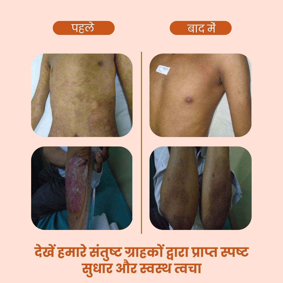 Welexcare: AyuDerme त्वचा की समस्याओं के लिए एक प्राकृतिक इलाज - Welex Care